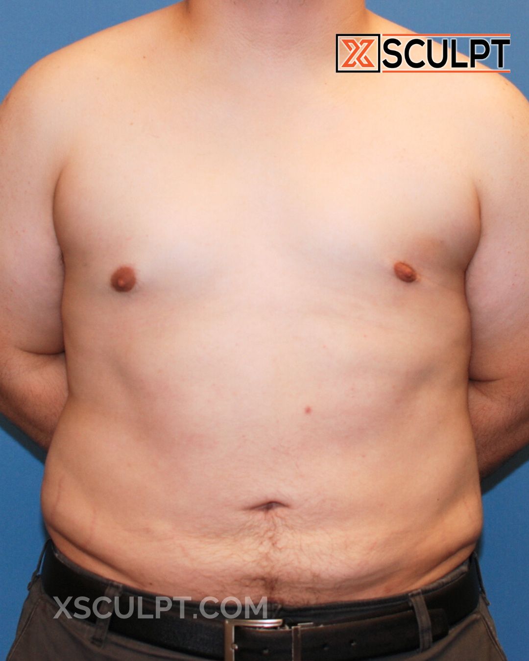 Gynecomastia ChestSculpt™ - Grade 1, Male Breast Reduction, VASER Lipo after photo 2, case #1220290, Dr. Marc Adajar, Chicago Breast & Body