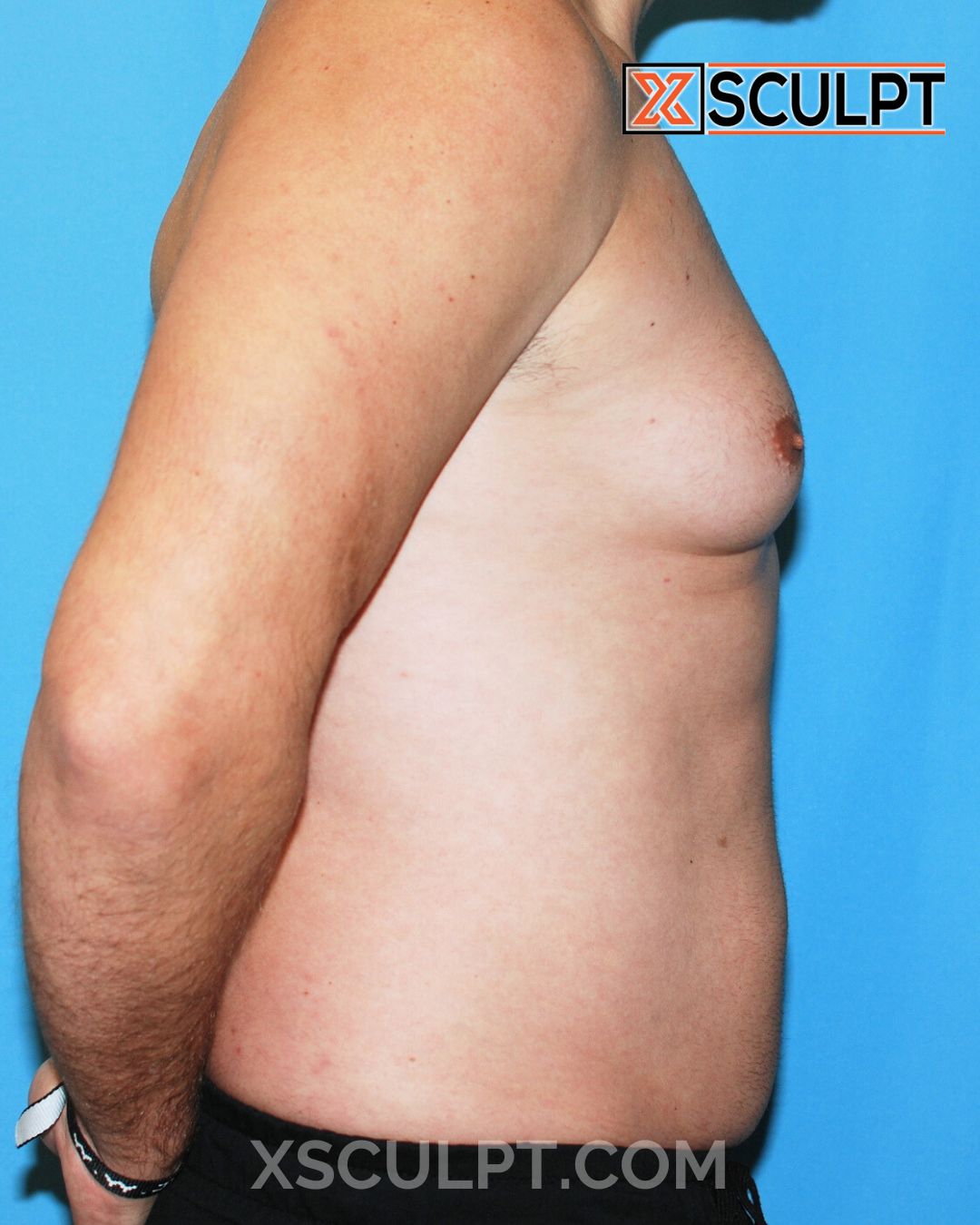 Gynecomastia ChestSculpt™ - Grade 3, Male Breast Reduction, Male Liposuction before photo 3, case #1293640, Dr. Anh-Tuan Truong, Chicago Breast & Body