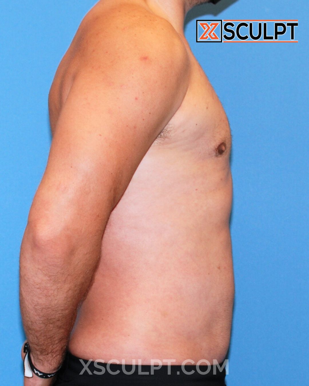Gynecomastia ChestSculpt™ - Grade 3, Male Breast Reduction, Male Liposuction after photo 3, case #1293640, Dr. Anh-Tuan Truong, Chicago Breast & Body