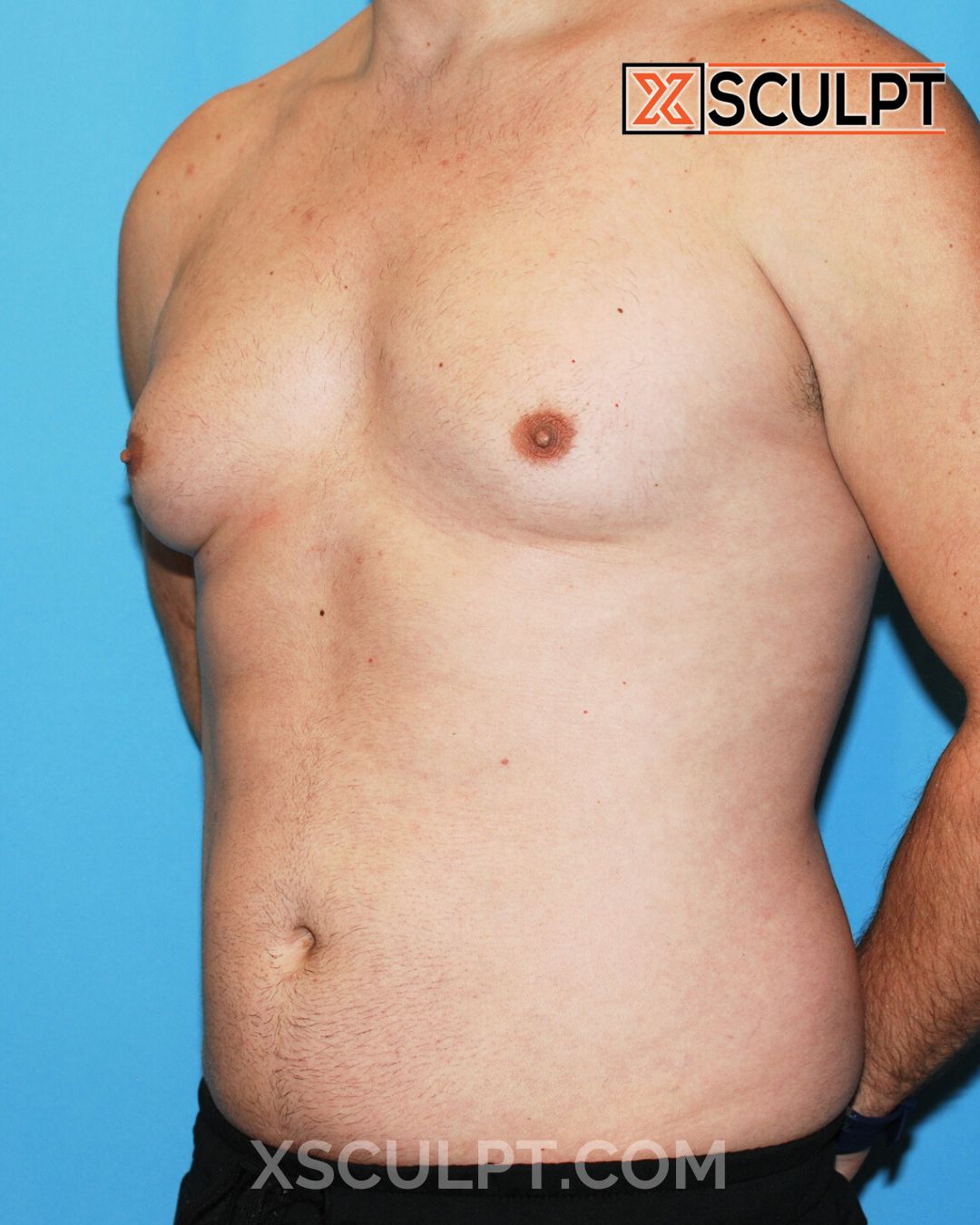 Gynecomastia ChestSculpt™ - Grade 3, Male Breast Reduction, Male Liposuction before photo 4, case #1293640, Dr. Anh-Tuan Truong, Chicago Breast & Body