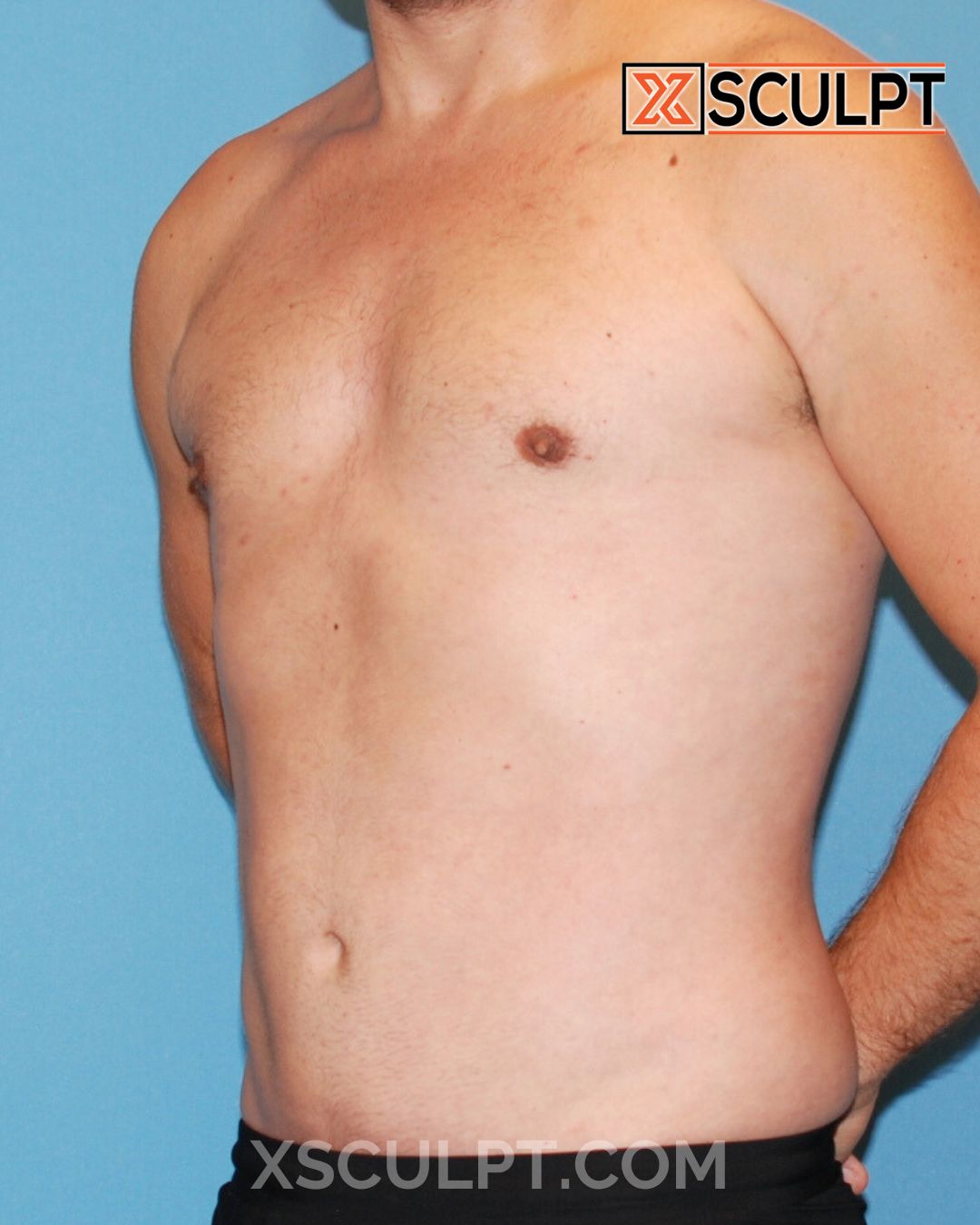 Gynecomastia ChestSculpt™ - Grade 3, Male Breast Reduction, Male Liposuction after photo 4, case #1293640, Dr. Anh-Tuan Truong, Chicago Breast & Body