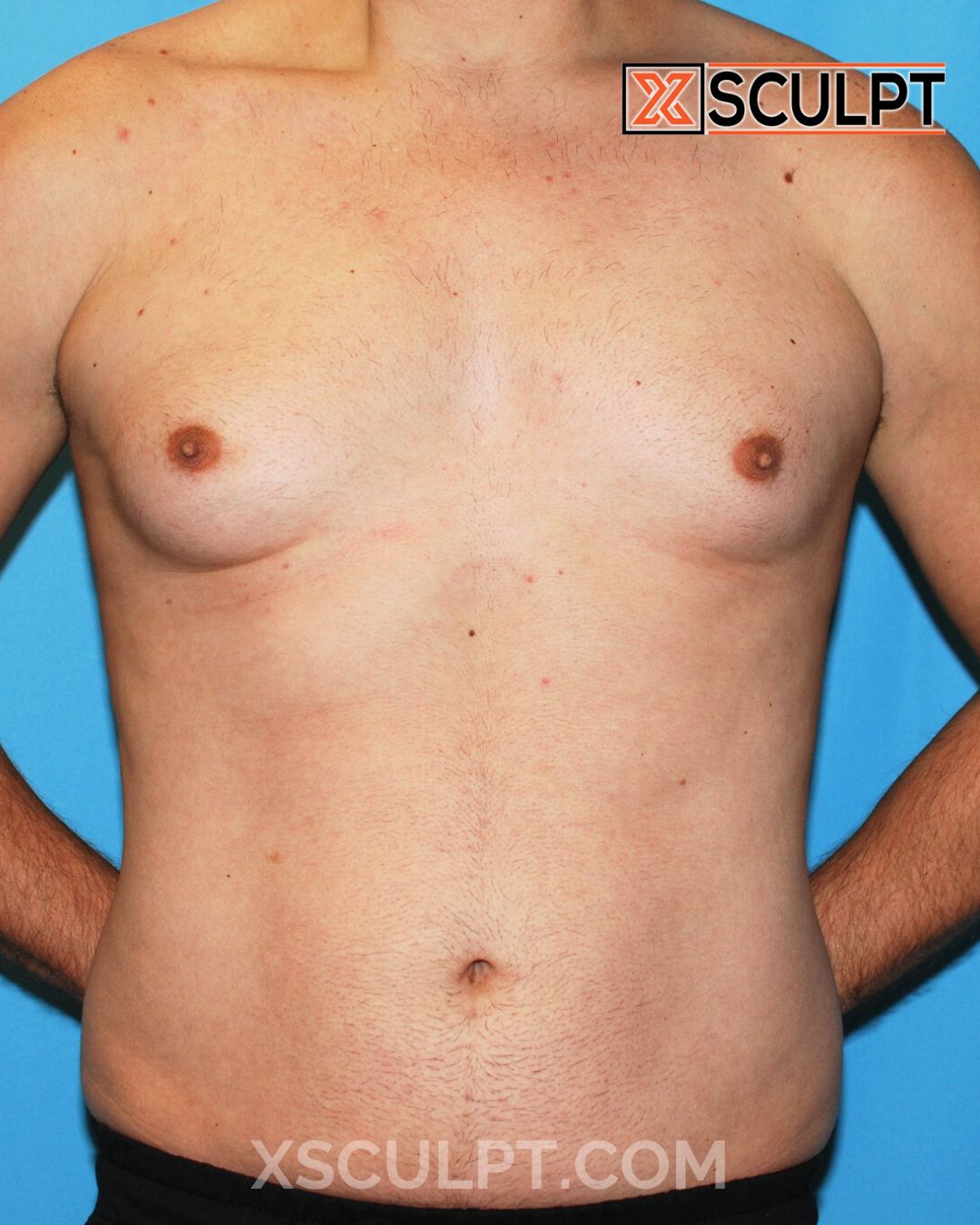 Gynecomastia ChestSculpt™ - Grade 3, Male Breast Reduction, Male Liposuction before photo 2, case #1293640, Dr. Anh-Tuan Truong, Chicago Breast & Body