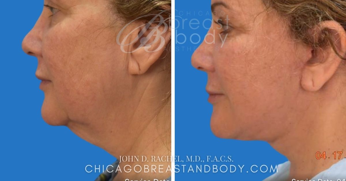 1453110 Neck Lift Before After Dr. John Rachel Chicago Breast And Body