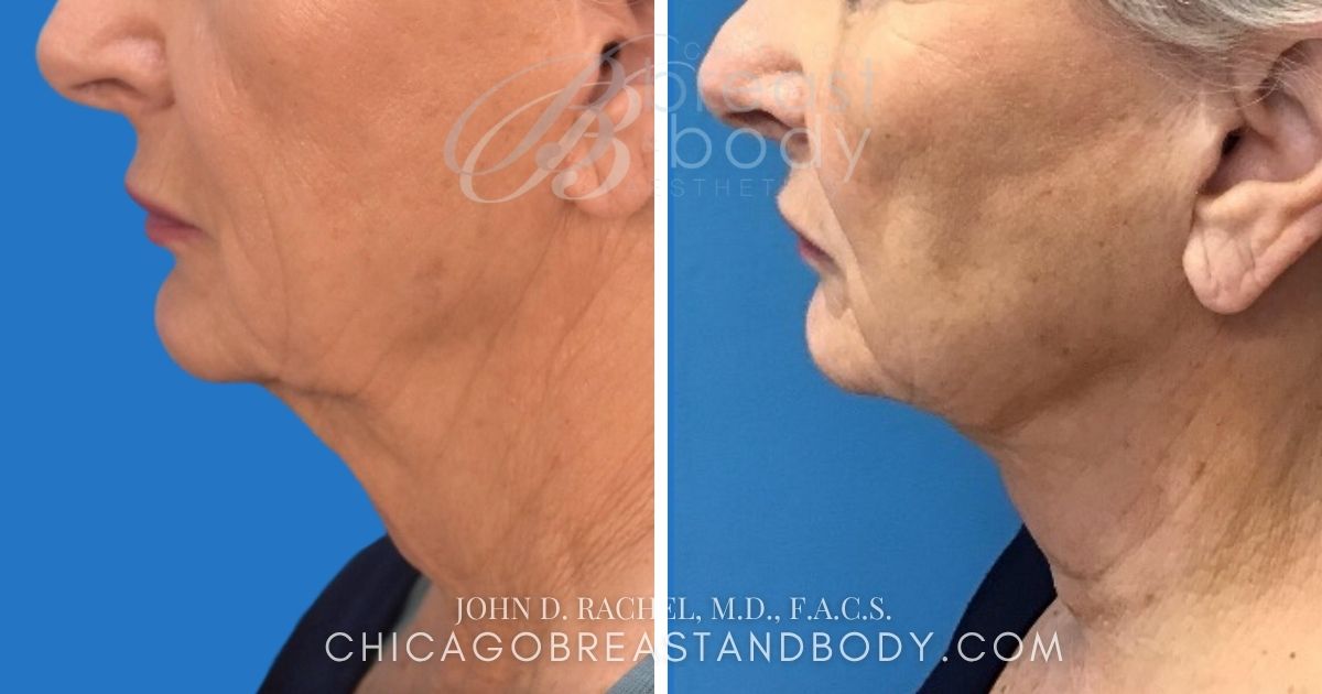 1453112 Neck Lift Before After Dr. John Rachel Chicago Breast And Body