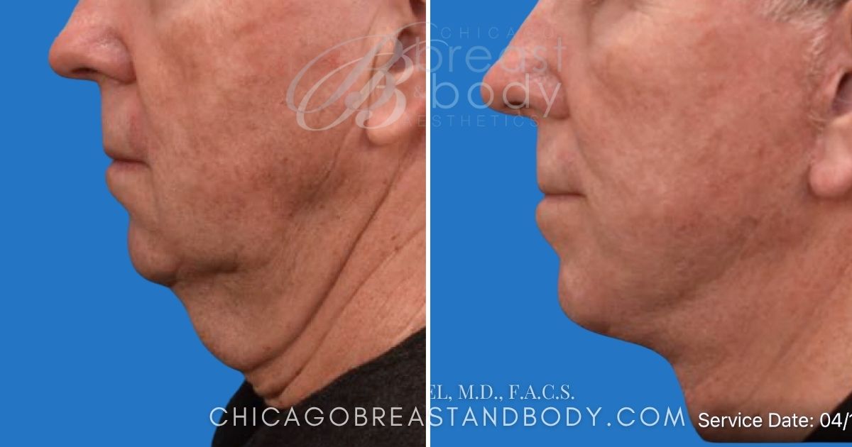 1453113 Male Lower Neck Lift Before After Dr. John Rachel Chicago Breast And Body