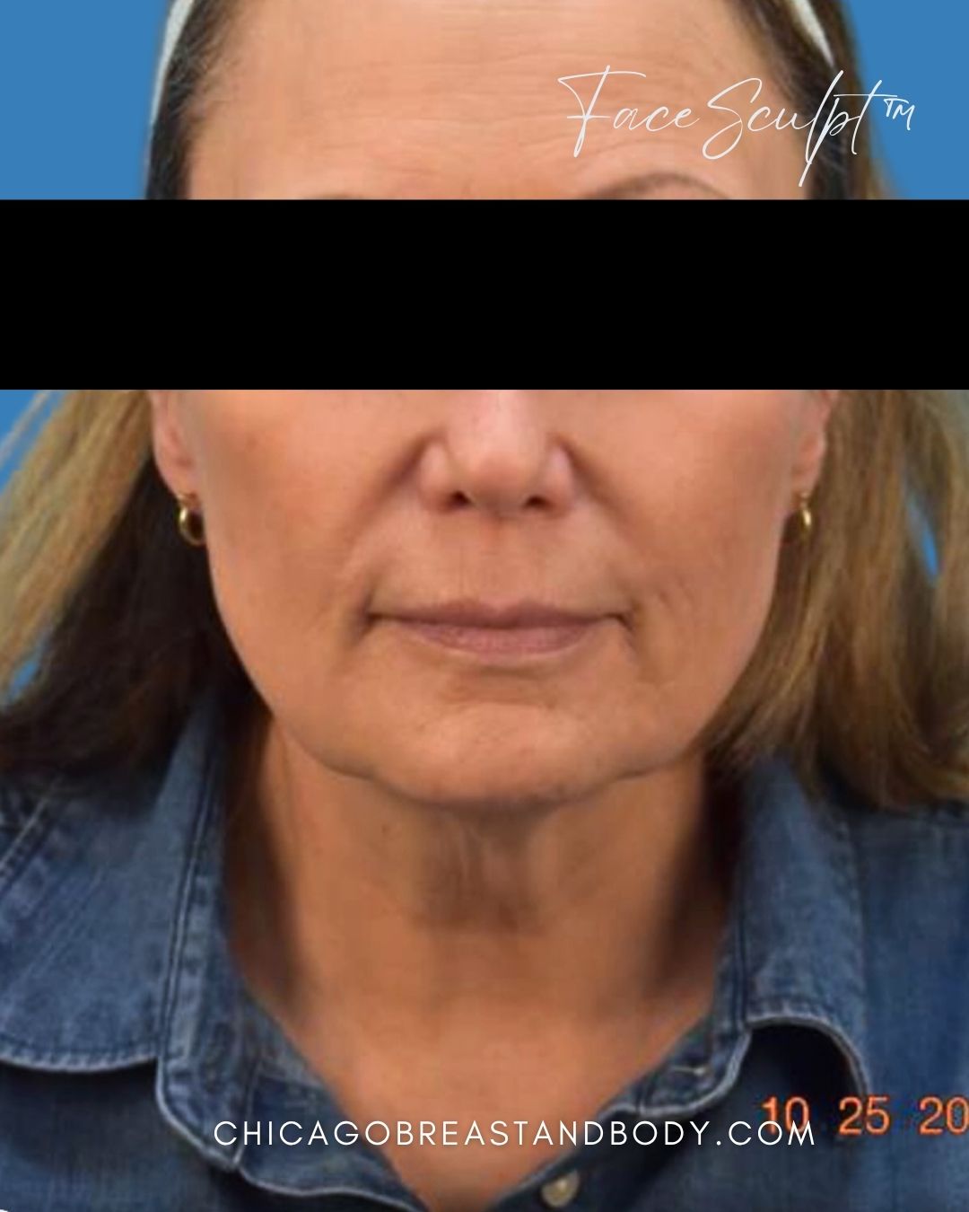 Necklift before photo 2, case #1453114, Dr. John Rachel, Chicago Breast & Body