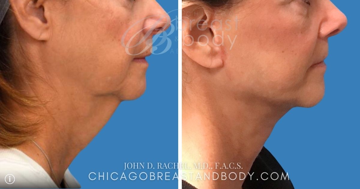 1453115 Lower Neck Lift Before After Dr. John Rachel Chicago Breast And Body