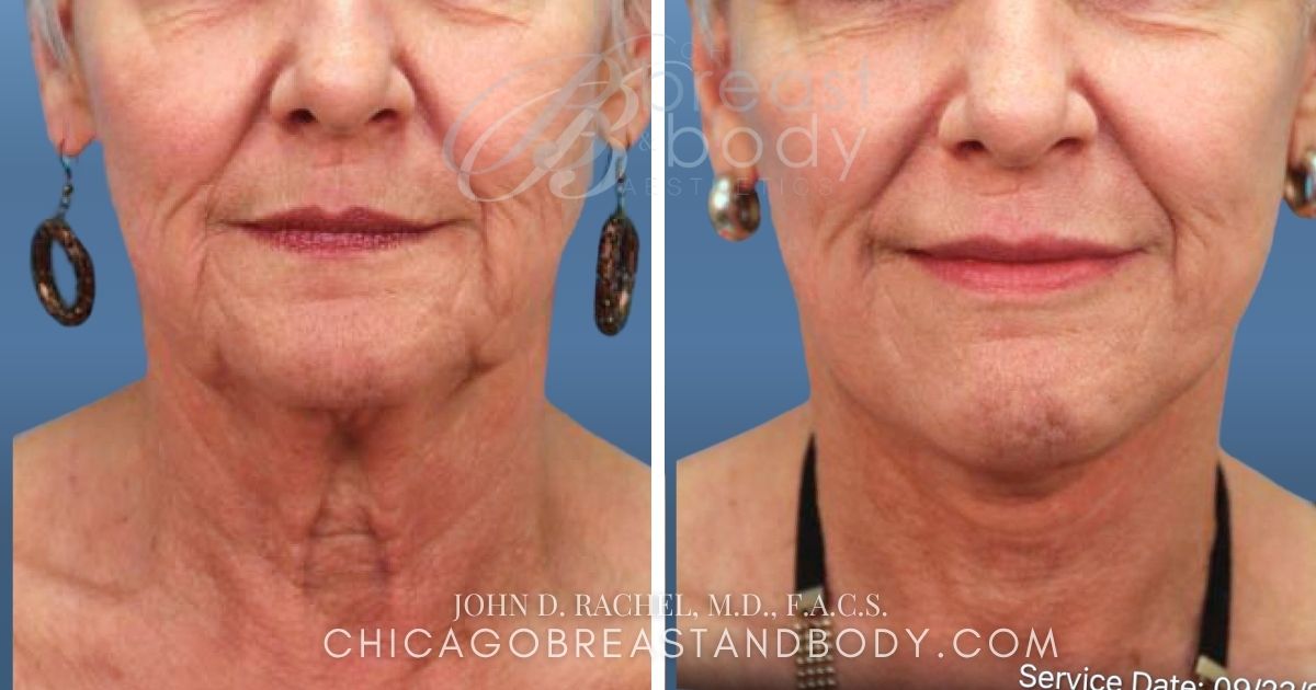 1453117 Neck Lift By Dr. John Rachel Chicago Breast And Body