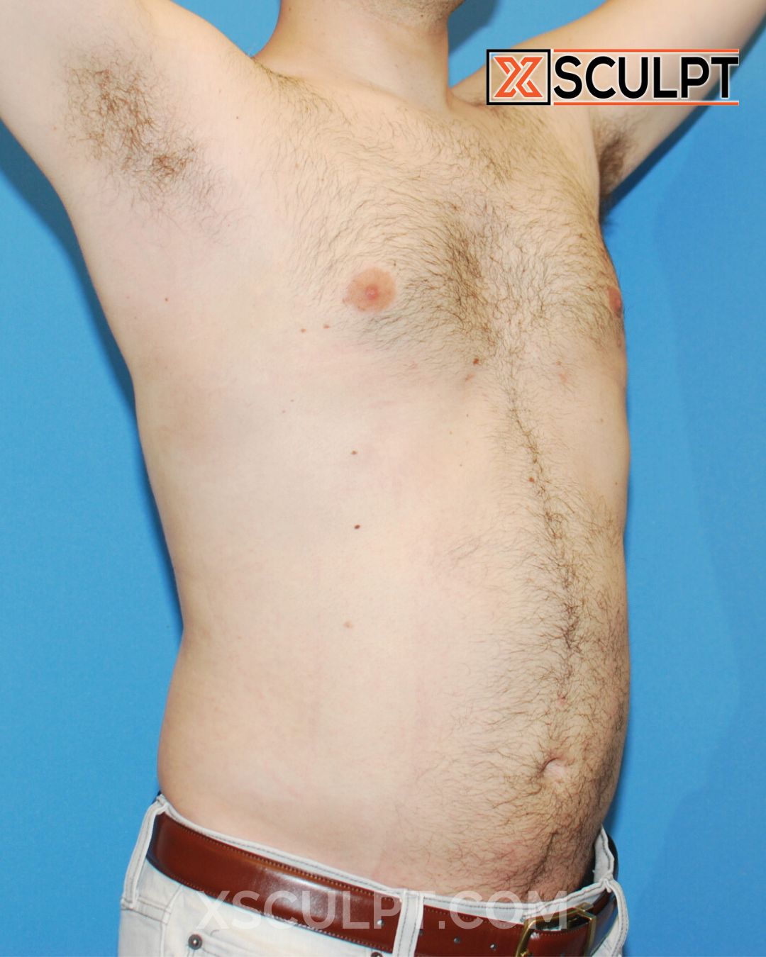 Gynecomastia ChestSculpt™ - Grade 1, Lipo 360, Liposuction after photo 4, case #1744161, Dr. Anh-Tuan Truong, Chicago Breast & Body