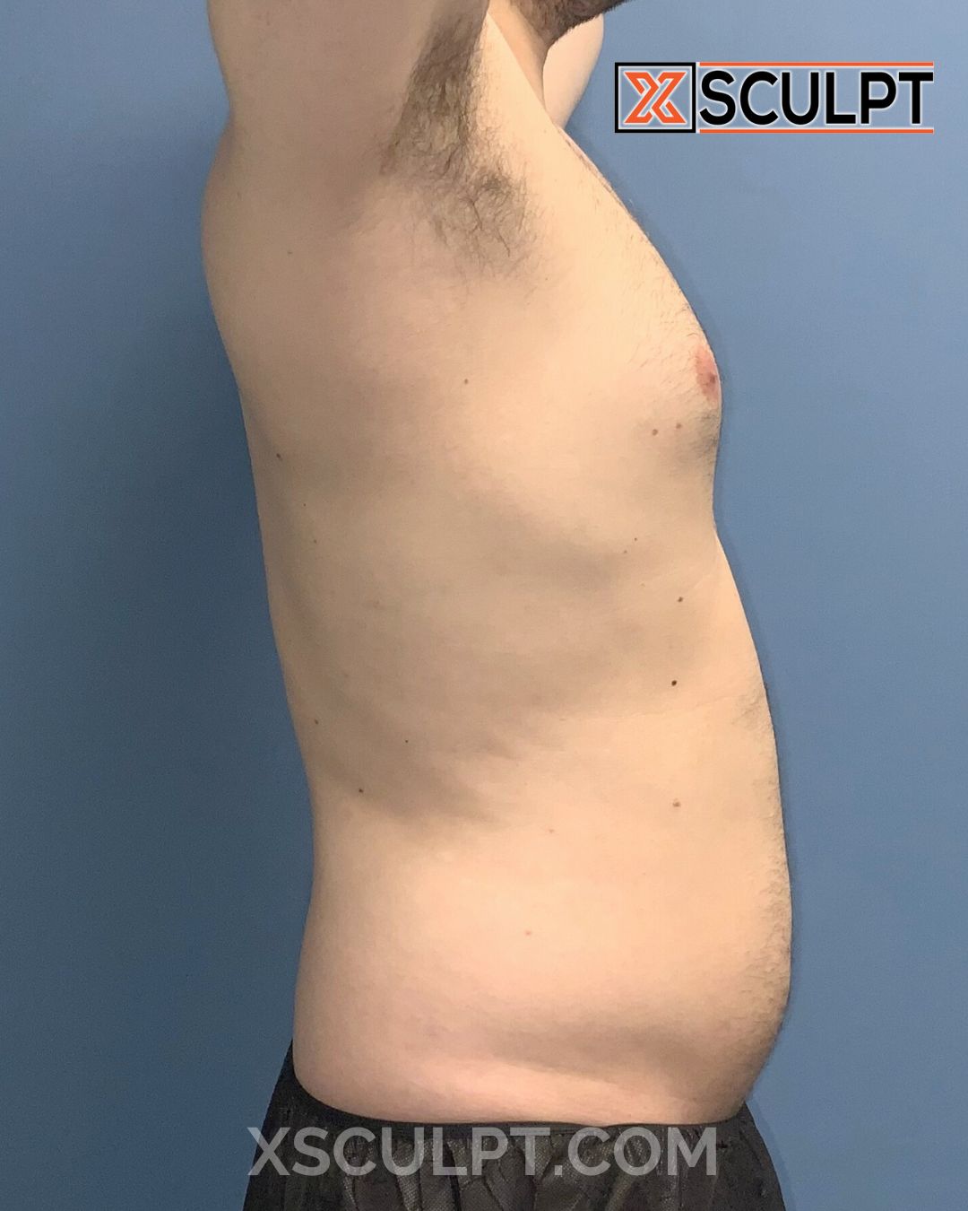 Gynecomastia ChestSculpt™ - Grade 1, Lipo 360, Liposuction before photo 5, case #1744161, Dr. Anh-Tuan Truong, Chicago Breast & Body