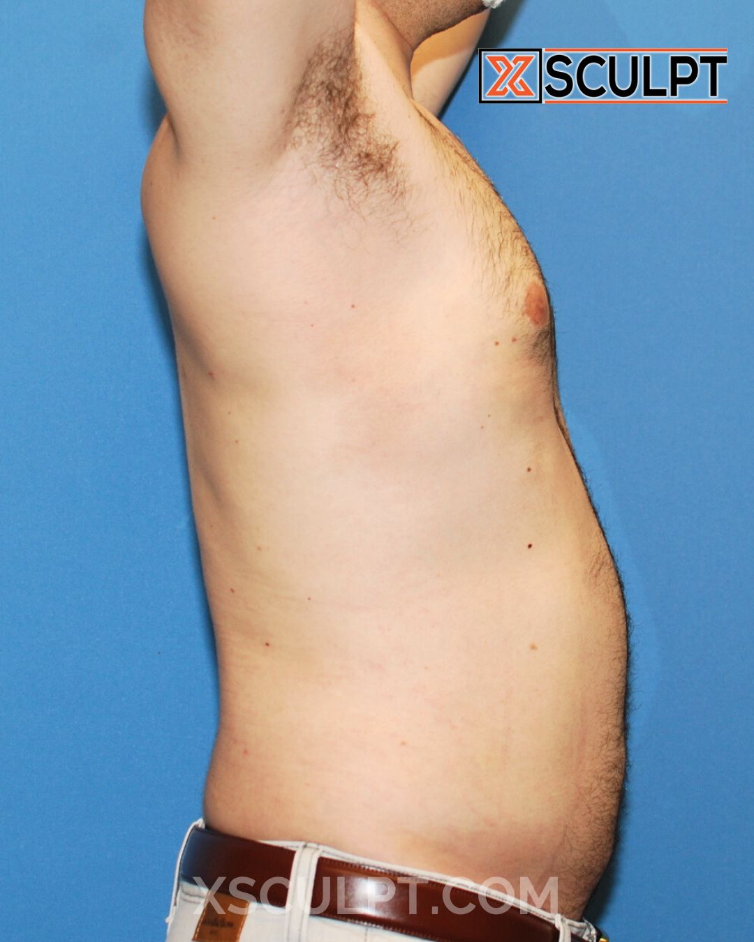 Gynecomastia ChestSculpt™ - Grade 1, Lipo 360, Liposuction after photo 5, case #1744161, Dr. Anh-Tuan Truong, Chicago Breast & Body