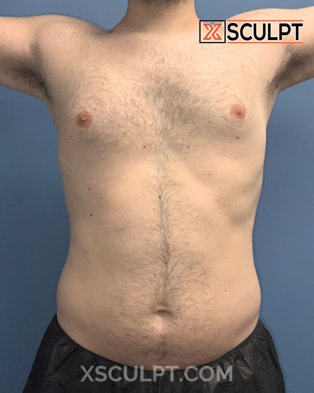 Gynecomastia ChestSculpt™ - Grade 1, Lipo 360, Liposuction before photo 3, case #1744161, Dr. Anh-Tuan Truong, Chicago Breast & Body