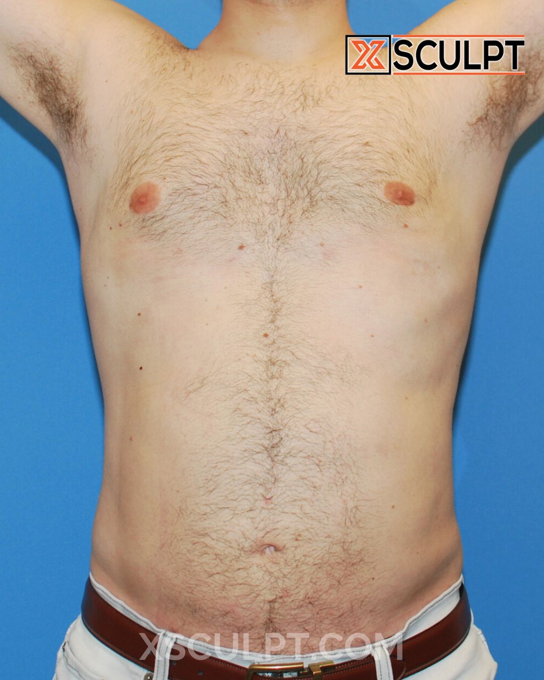 Gynecomastia ChestSculpt™ - Grade 1, Lipo 360, Liposuction after photo 3, case #1744161, Dr. Anh-Tuan Truong, Chicago Breast & Body