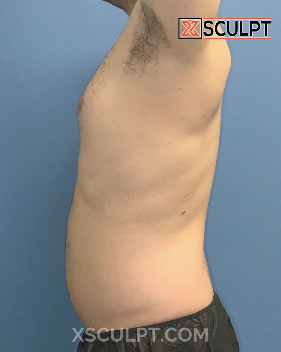 Gynecomastia ChestSculpt™ - Grade 1, Lipo 360, Liposuction after photo 2, case #1744161, Dr. Anh-Tuan Truong, Chicago Breast & Body
