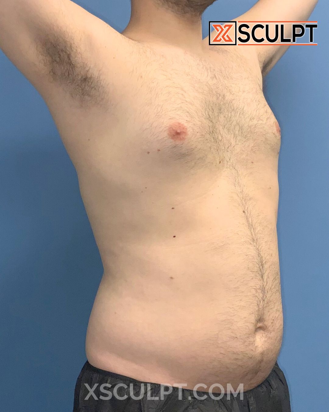 Gynecomastia ChestSculpt™ - Grade 1, Lipo 360, Liposuction before photo 4, case #1744161, Dr. Anh-Tuan Truong, Chicago Breast & Body