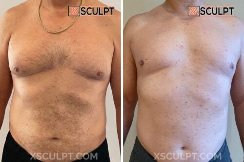 1760537 Grade 1 Gynecomastia Dr. Adajar Chicago 3mos