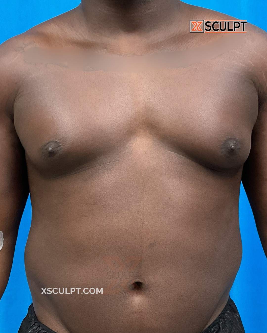 Gynecomastia ChestSculpt™ - Grade 3, Liposuction, Male Breast Reduction before photo 2, case #1971489, Dr. Marc Adajar, Chicago Breast & Body