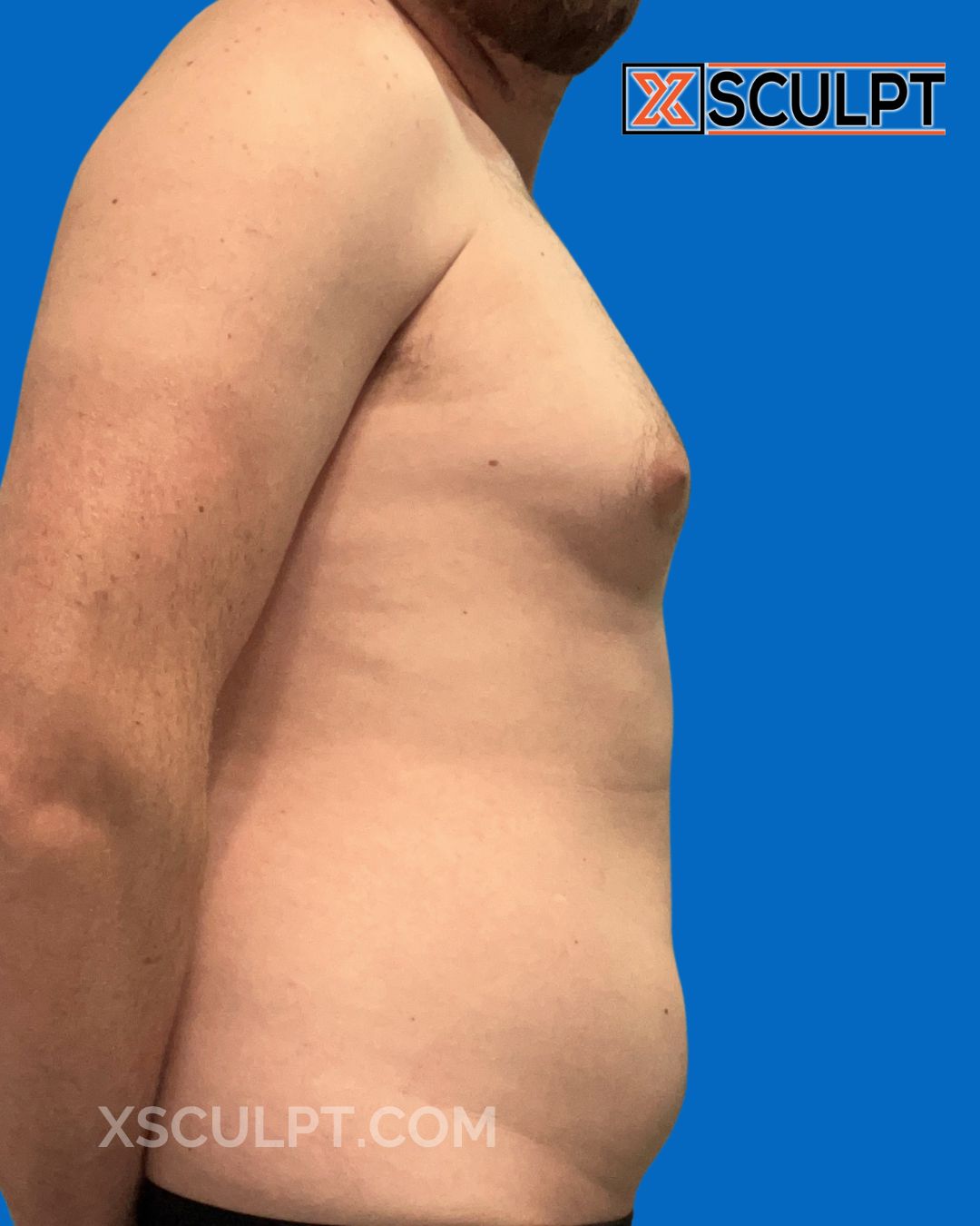 Gynecomastia ChestSculpt™ - Grade 3, Liposuction, Male Breast Reduction before photo 2, case #2327176, Dr. Marc Adajar, Chicago Breast & Body