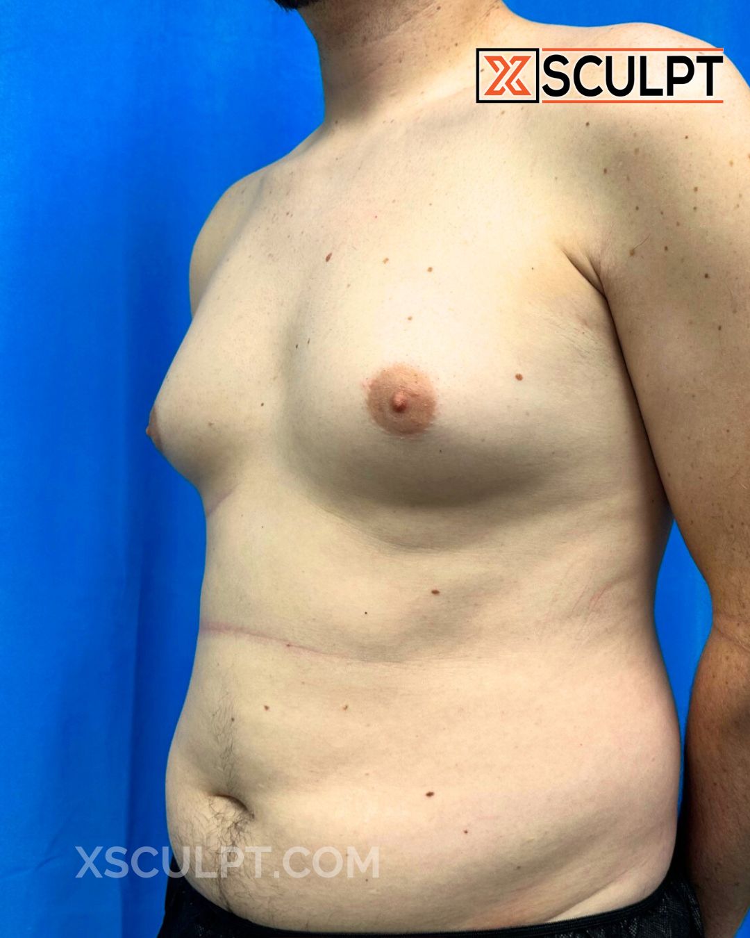 Gynecomastia ChestSculpt™ - Grade 3, Liposuction, Male Breast Reduction before photo 4, case #2327176, Dr. Marc Adajar, Chicago Breast & Body
