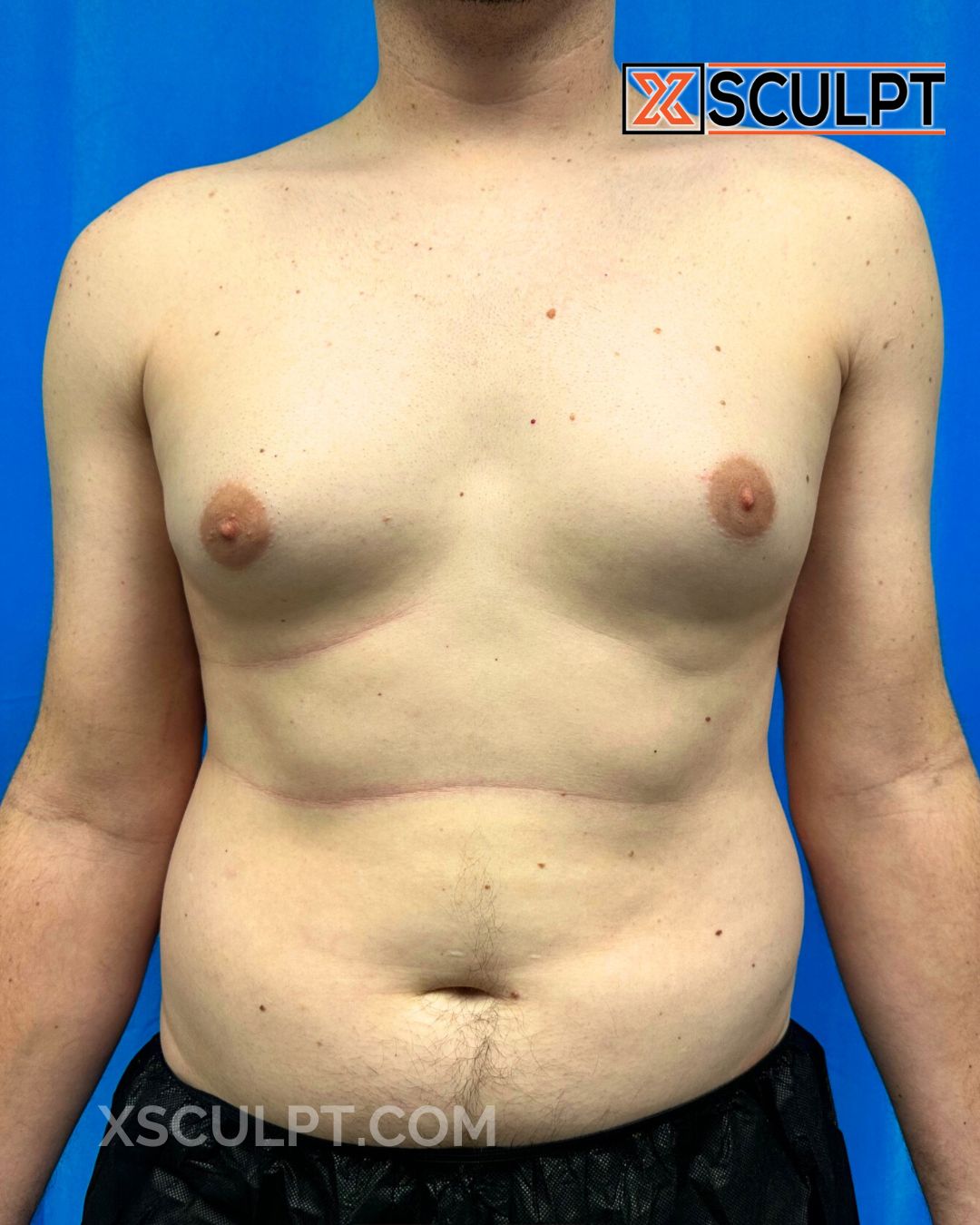 Gynecomastia ChestSculpt™ - Grade 3, Liposuction, Male Breast Reduction before photo 3, case #2327176, Dr. Marc Adajar, Chicago Breast & Body