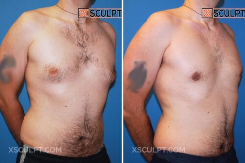 25000 Grade 1 Gynecomastia Dr. Truong Chicago