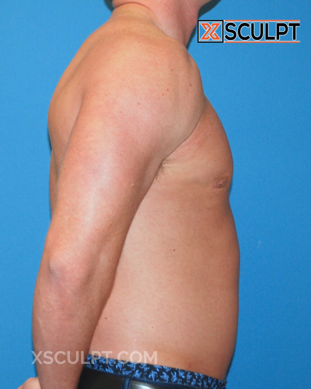 Gynecomastia ChestSculpt™ - Grade 1, Liposuction, Male Breast Reduction after photo 4, case #26000, Dr. Anh-Tuan Truong, Chicago Breast & Body