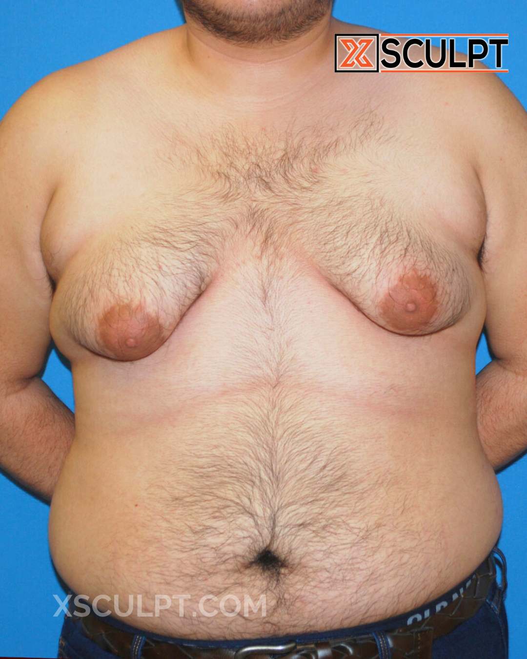 Gynecomastia ChestSculpt™ - Grade 4, Liposuction, Male Breast Reduction before photo 3, case #29000, Dr. Anh-Tuan Truong, Chicago Breast & Body