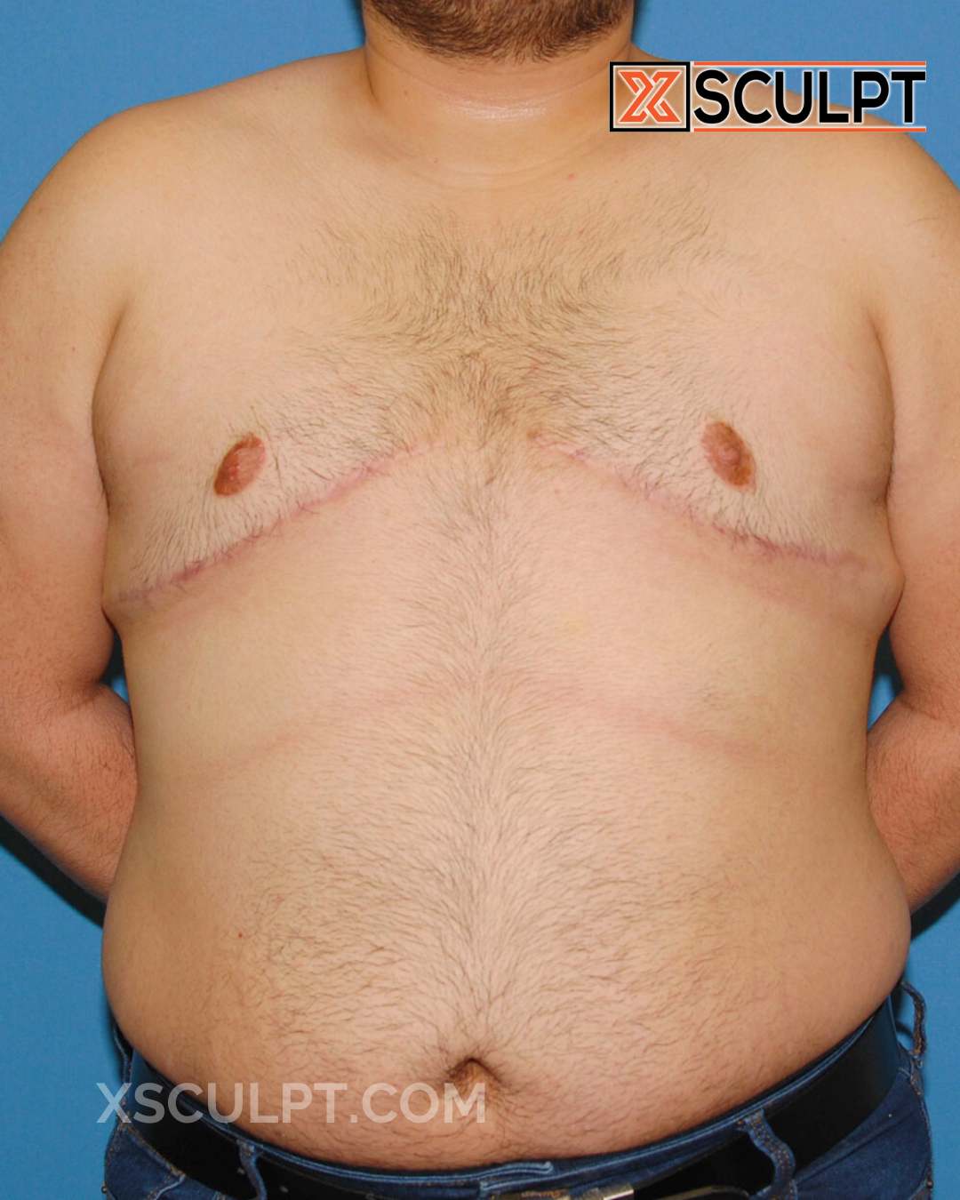 Gynecomastia ChestSculpt™ - Grade 4, Liposuction, Male Breast Reduction after photo 3, case #29000, Dr. Anh-Tuan Truong, Chicago Breast & Body