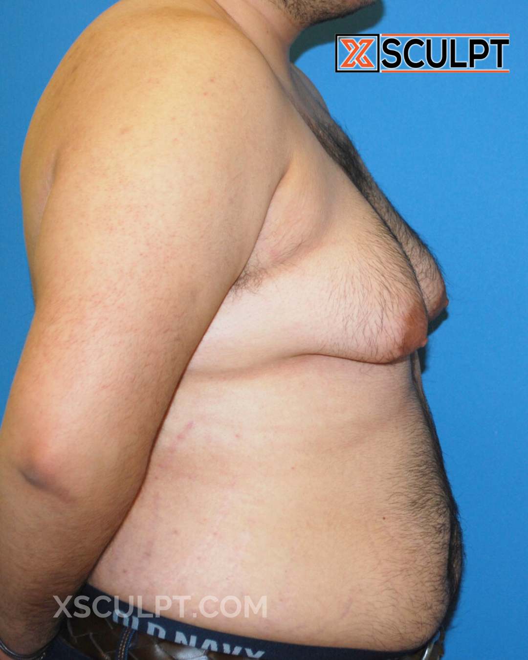 Gynecomastia ChestSculpt™ - Grade 4, Liposuction, Male Breast Reduction before photo 2, case #29000, Dr. Anh-Tuan Truong, Chicago Breast & Body