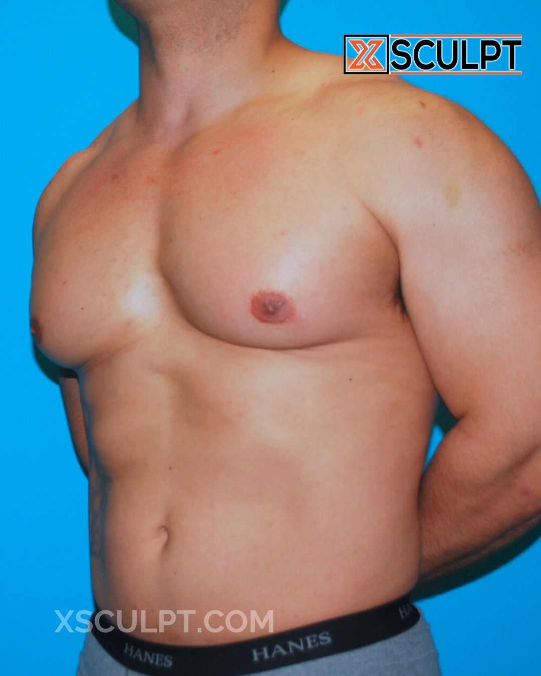 Gynecomastia ChestSculpt™ - Grade 3, Liposuction, Male Breast Reduction before photo 3, case #30000, Dr. Anh-Tuan Truong, Chicago Breast & Body