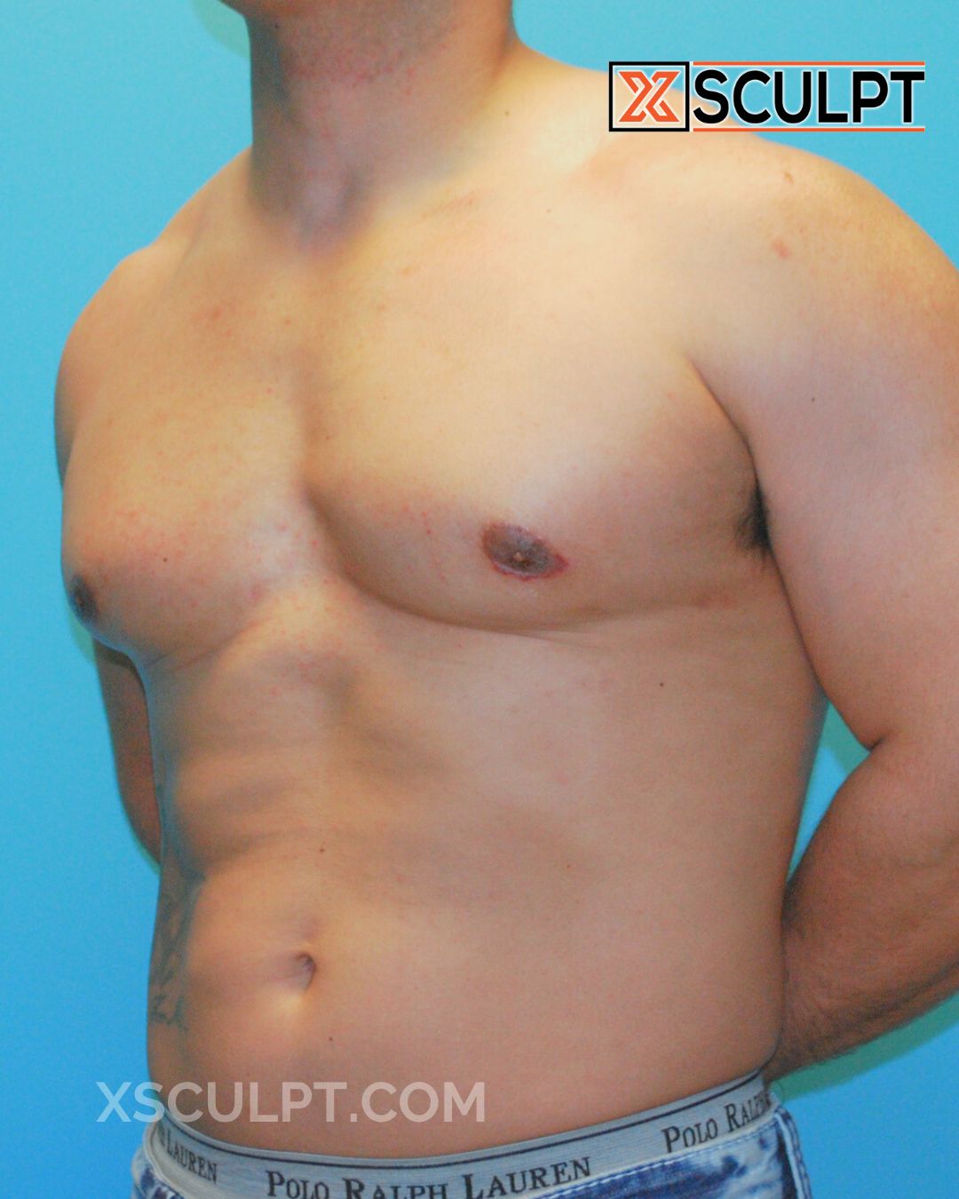 Gynecomastia ChestSculpt™ - Grade 3, Liposuction, Male Breast Reduction after photo 3, case #30000, Dr. Anh-Tuan Truong, Chicago Breast & Body