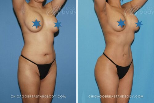 31635 Bbl Vaser Lipo Dr. Truong Chicago