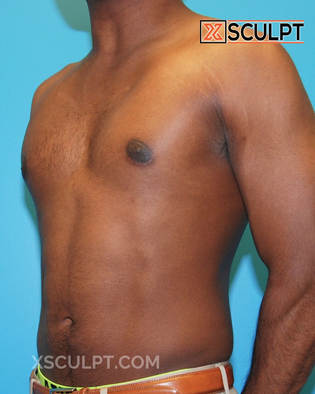 Gynecomastia ChestSculpt™ - Grade 1, Liposuction, Male Breast Reduction after photo 3, case #32000, Dr. Anh-Tuan Truong, Chicago Breast & Body