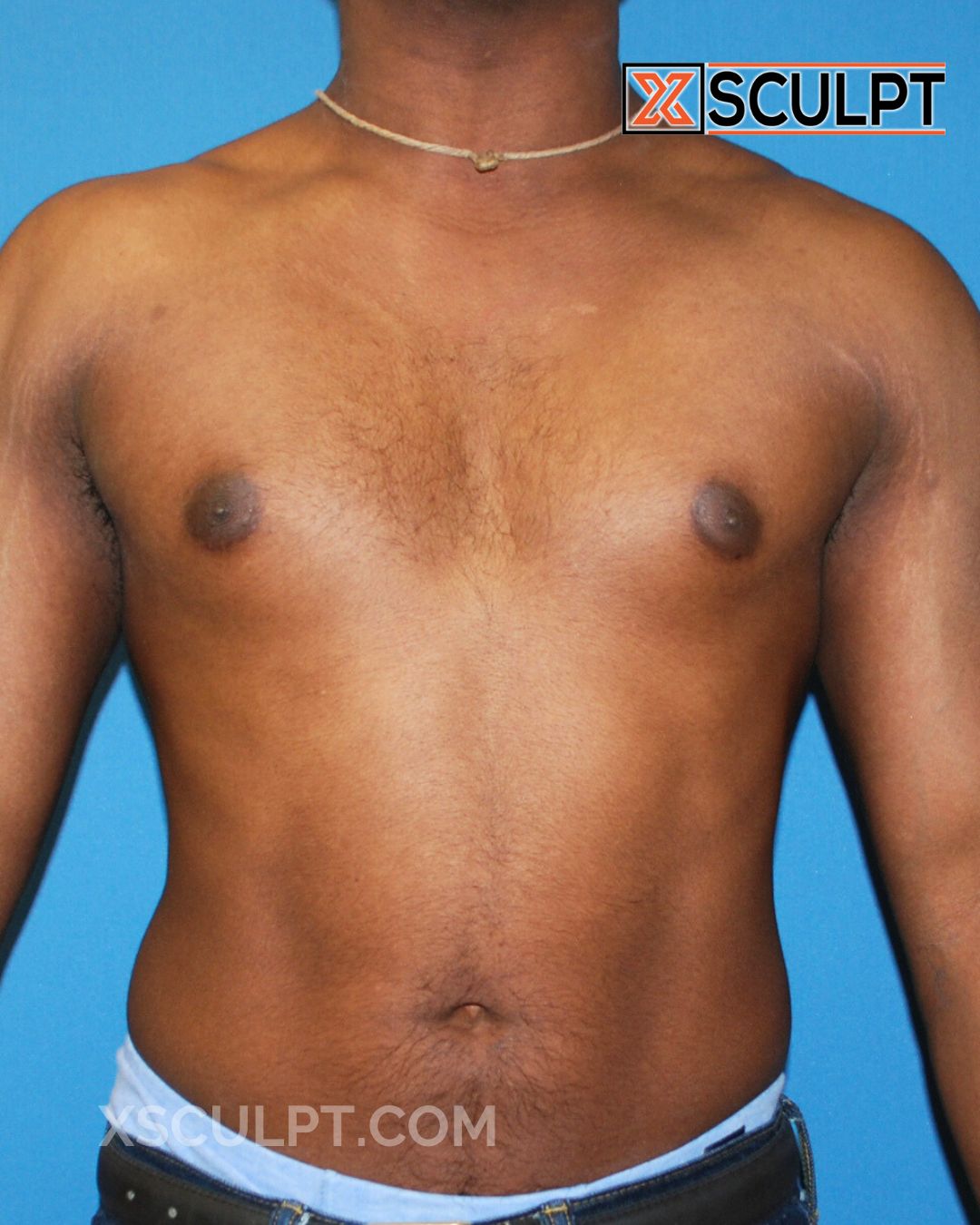 Gynecomastia ChestSculpt™ - Grade 1, Liposuction, Male Breast Reduction before photo 2, case #32000, Dr. Anh-Tuan Truong, Chicago Breast & Body