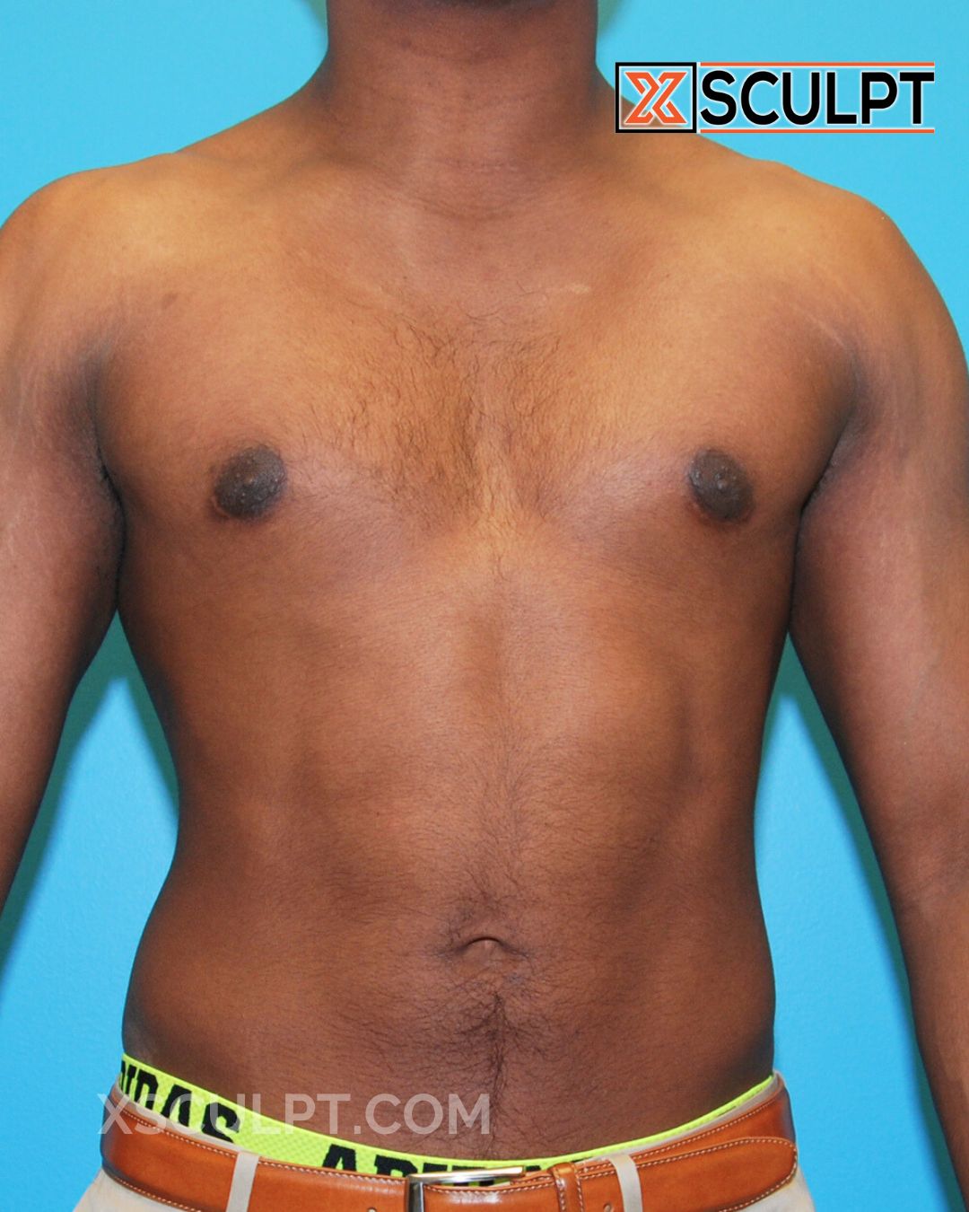 Gynecomastia ChestSculpt™ - Grade 1, Liposuction, Male Breast Reduction after photo 2, case #32000, Dr. Anh-Tuan Truong, Chicago Breast & Body