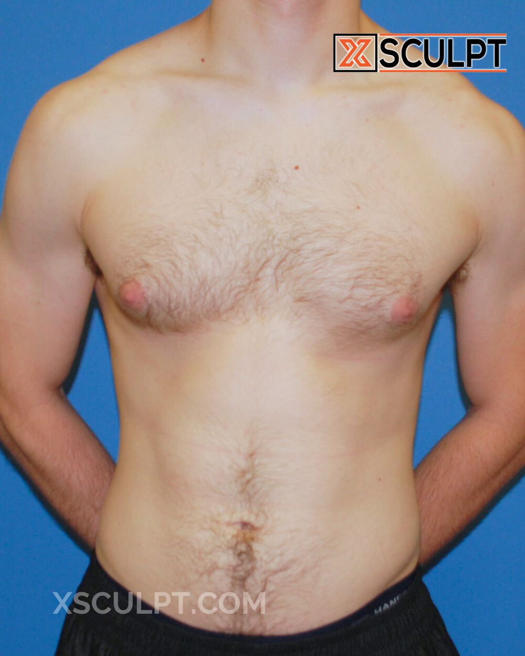 Gynecomastia ChestSculpt™ - Grade 2, Liposuction, Male Breast Reduction before photo 2, case #34000, Dr. Anh-Tuan Truong, Chicago Breast & Body