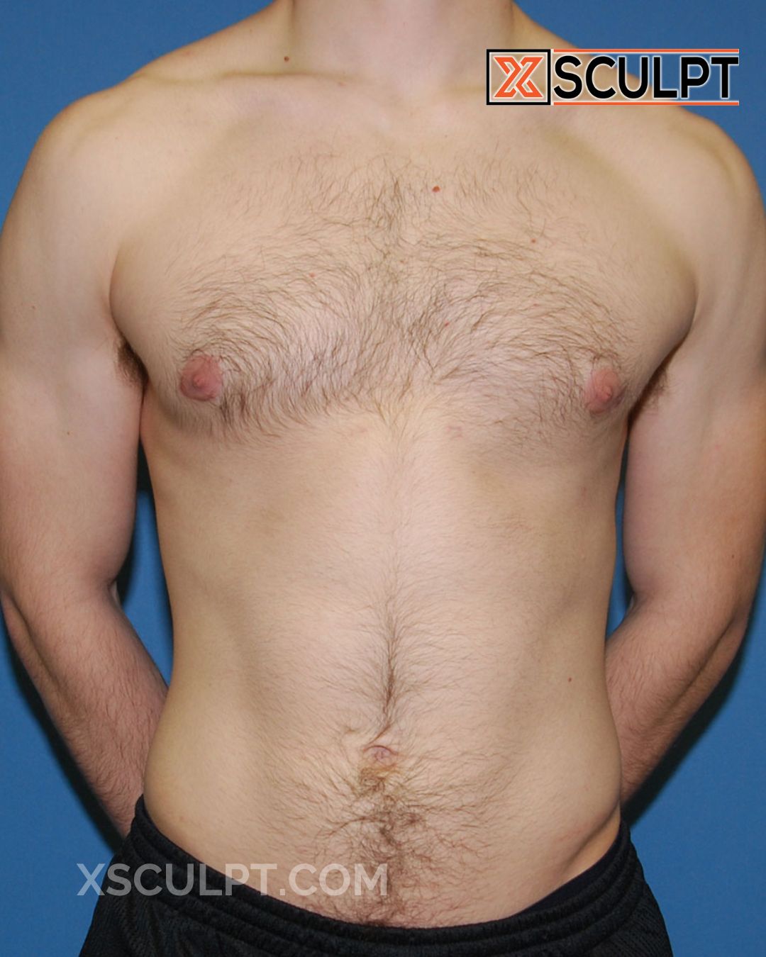Gynecomastia ChestSculpt™ - Grade 2, Liposuction, Male Breast Reduction after photo 2, case #34000, Dr. Anh-Tuan Truong, Chicago Breast & Body