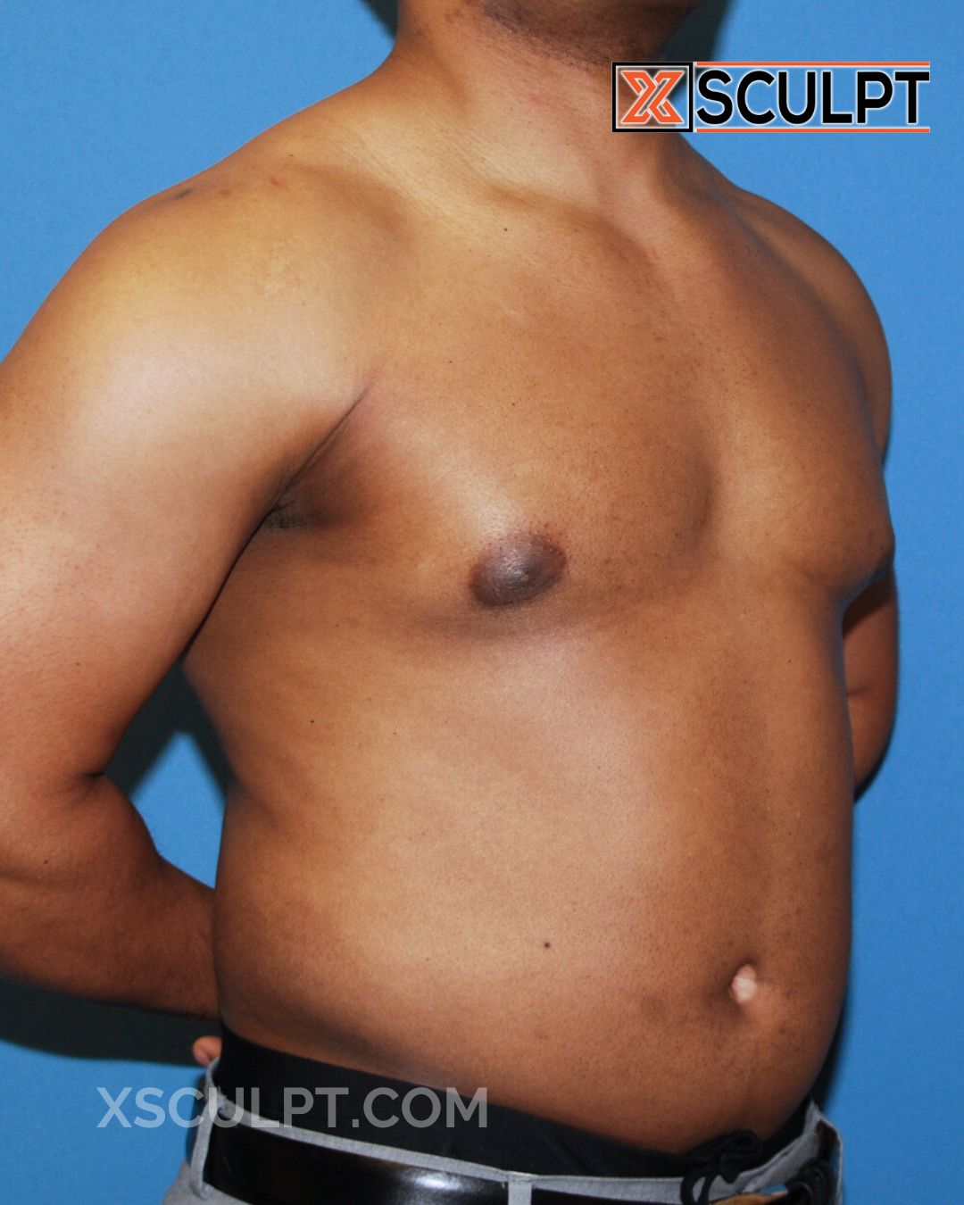 Gynecomastia ChestSculpt™ - Grade 2, Liposuction, Male Breast Reduction before photo 3, case #36000, Dr. Anh-Tuan Truong, Chicago Breast & Body