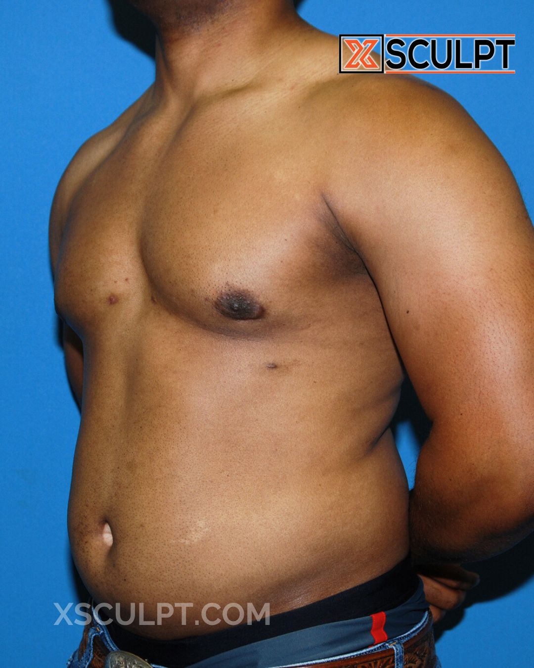 Gynecomastia ChestSculpt™ - Grade 2, Liposuction, Male Breast Reduction after photo 1, case #36000, Dr. Anh-Tuan Truong, Chicago Breast & Body