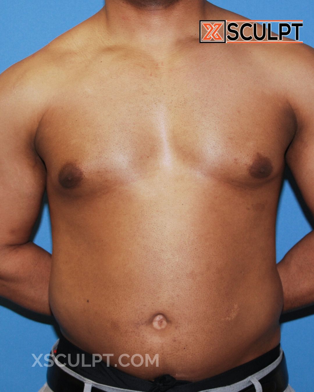 Gynecomastia ChestSculpt™ - Grade 2, Liposuction, Male Breast Reduction before photo 2, case #36000, Dr. Anh-Tuan Truong, Chicago Breast & Body