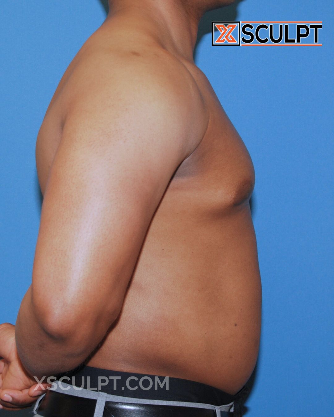 Gynecomastia ChestSculpt™ - Grade 2, Liposuction, Male Breast Reduction before photo 4, case #36000, Dr. Anh-Tuan Truong, Chicago Breast & Body