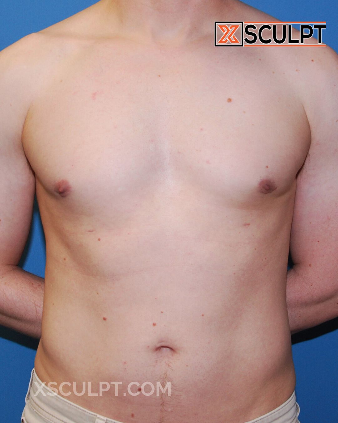 Gynecomastia ChestSculpt™ - Grade 2, Liposuction, Male Breast Reduction after photo 3, case #38000, Dr. Anh-Tuan Truong, Chicago Breast & Body