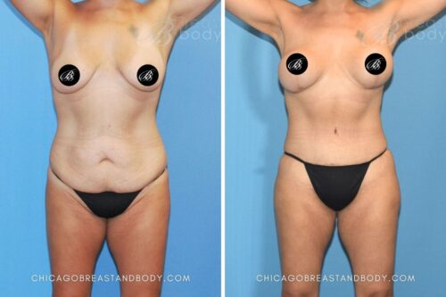 1741181-Mastopexy-and-TT-by-Dr.-Anh-Tuan-Truong-1yr