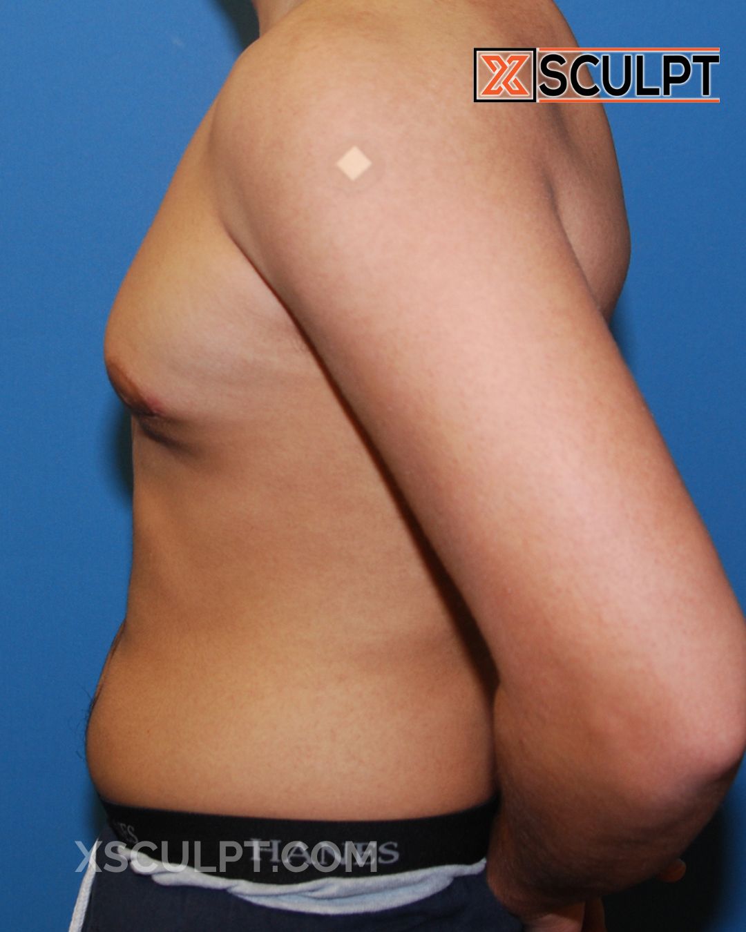 Gynecomastia ChestSculpt™ - Grade 3, Liposuction, Male Breast Reduction after photo 3, case #39000, Dr. Anh-Tuan Truong, Chicago Breast & Body