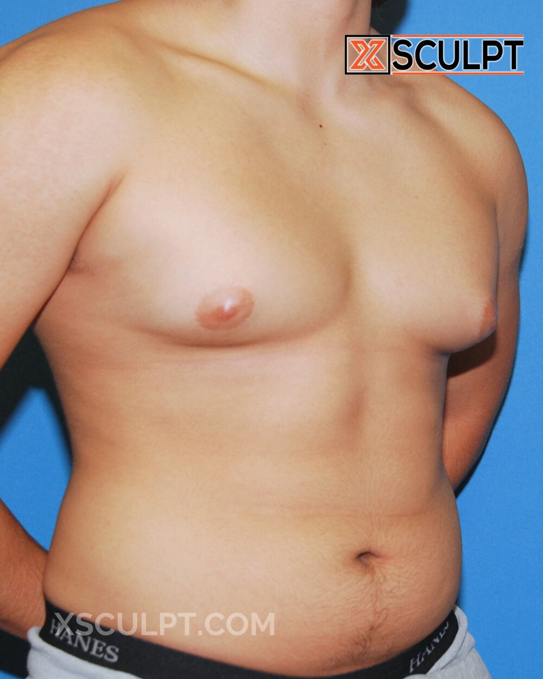 Gynecomastia ChestSculpt™ - Grade 3, Liposuction, Male Breast Reduction before photo 2, case #39000, Dr. Anh-Tuan Truong, Chicago Breast & Body