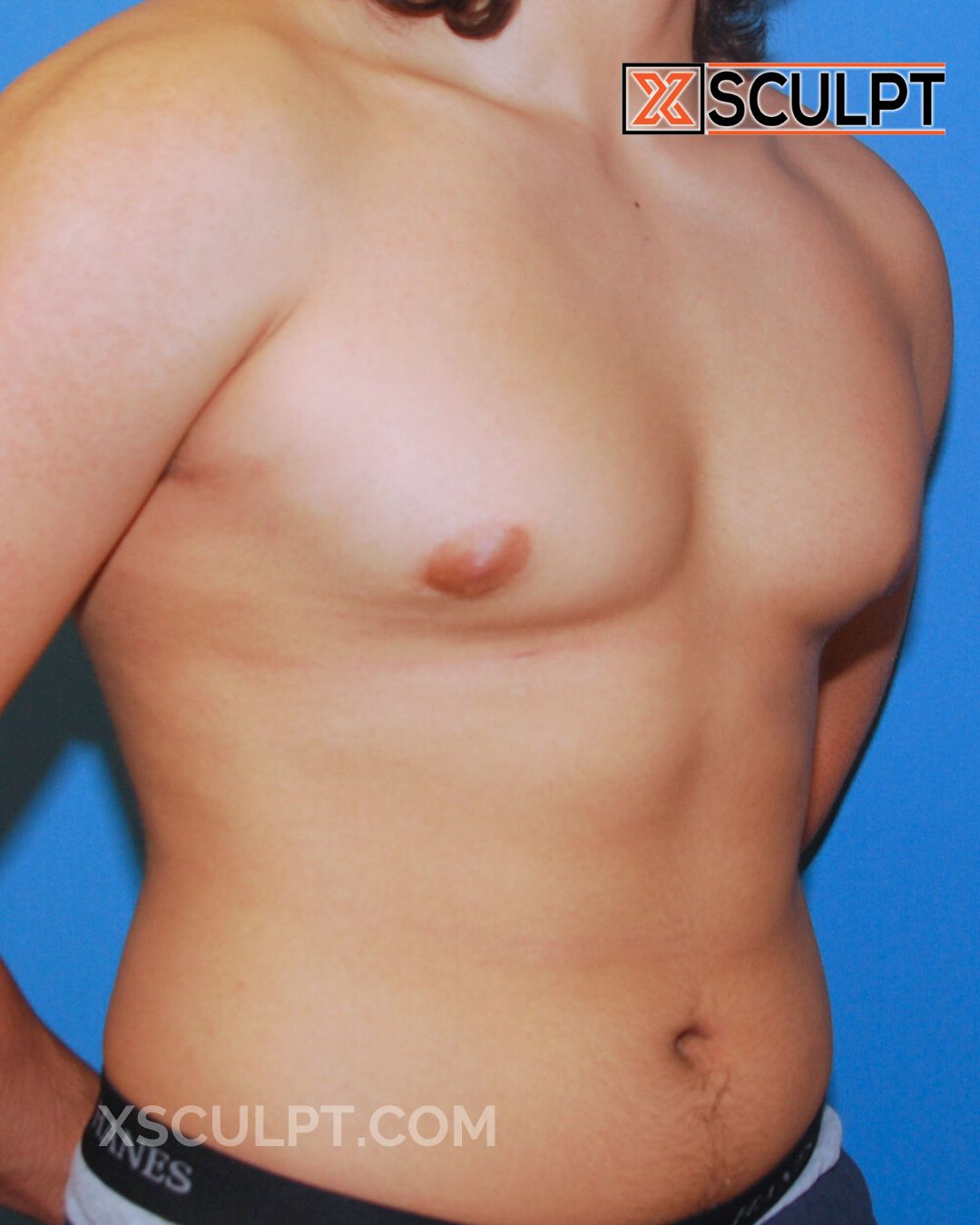 Gynecomastia ChestSculpt™ - Grade 3, Liposuction, Male Breast Reduction after photo 2, case #39000, Dr. Anh-Tuan Truong, Chicago Breast & Body