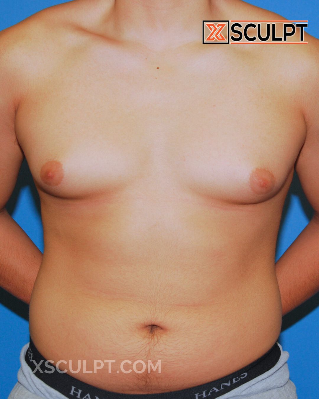 Gynecomastia ChestSculpt™ - Grade 3, Liposuction, Male Breast Reduction before photo 4, case #39000, Dr. Anh-Tuan Truong, Chicago Breast & Body