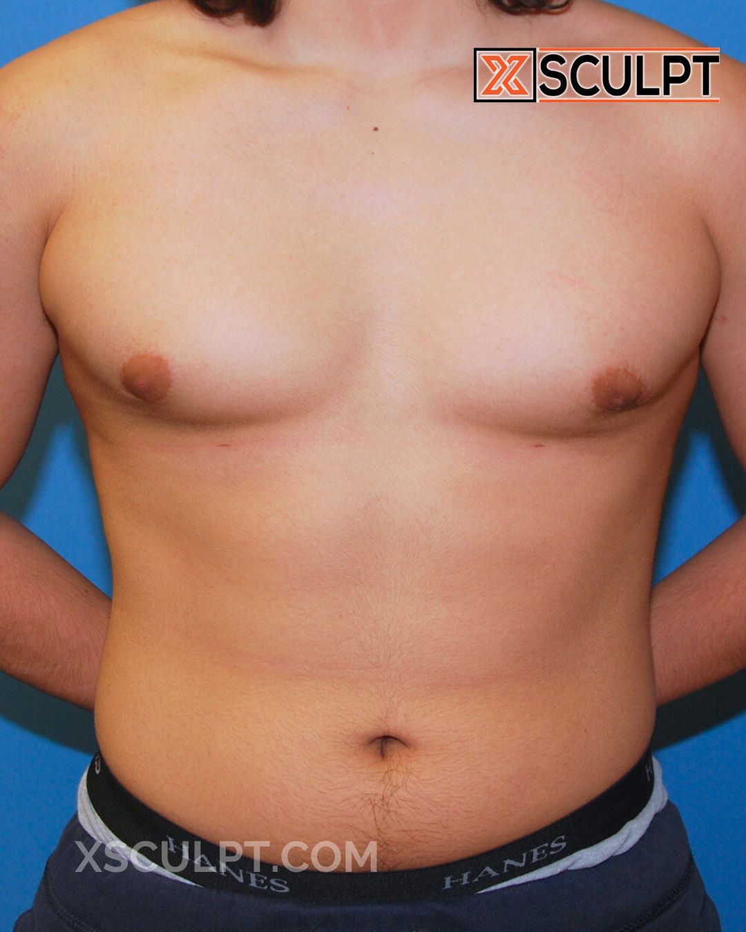 Gynecomastia ChestSculpt™ - Grade 3, Liposuction, Male Breast Reduction after photo 4, case #39000, Dr. Anh-Tuan Truong, Chicago Breast & Body
