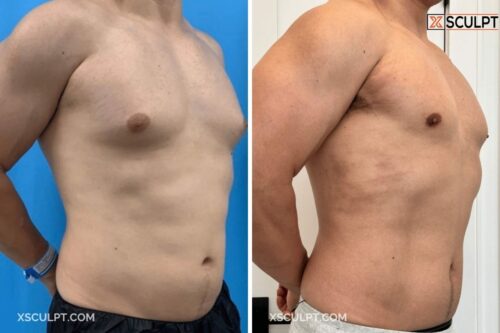 40497 Grade 2 Gynecomastia Dr. Adajar Chicago 3mos