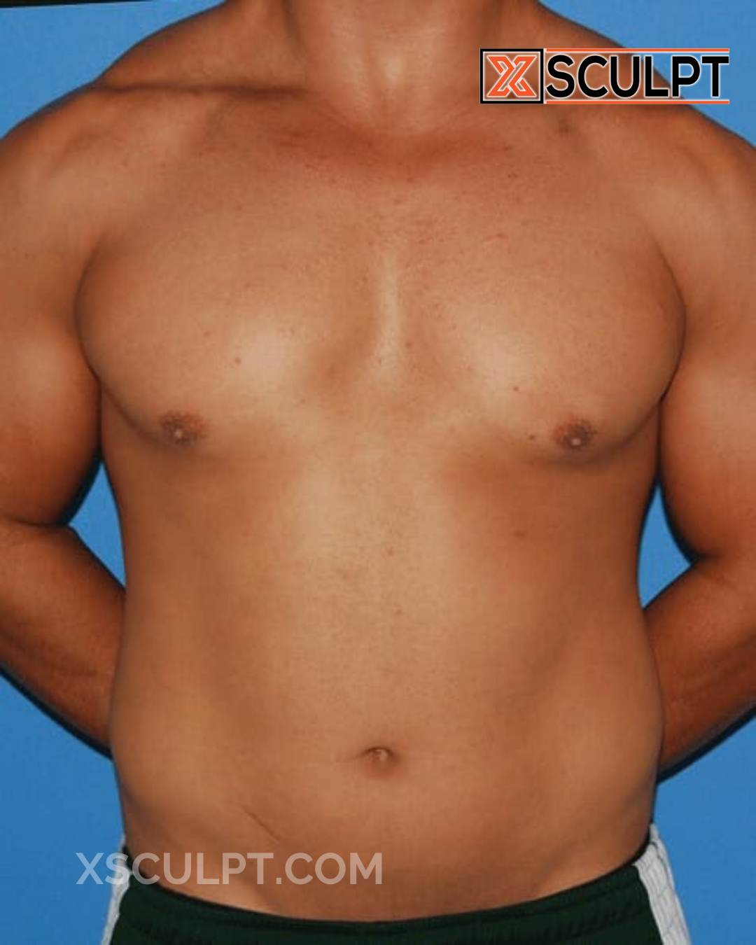 Gynecomastia ChestSculpt™ - Grade 2, Liposuction, Male Breast Reduction after photo 2, case #408b, Dr. Anh-Tuan Truong, Chicago Breast & Body